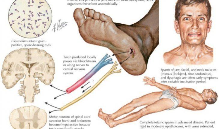 Dẫm phải đinh gỉ người bệnh mắc phải uốn ván nguy kịch