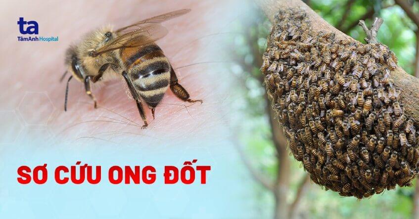 Cách sơ cứu ong đốt: Hướng dẫn xử trí đúng cách ngay tại nhà