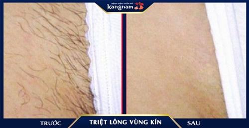 7 Bước Cạo lông vùng kín Đúng cách, Không ngứa cho Nam, Nữ