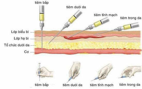 Tiêm bắp Mông Đùi - Tiêm Rụng trứng IVF - cách tiêm mông an toàn?