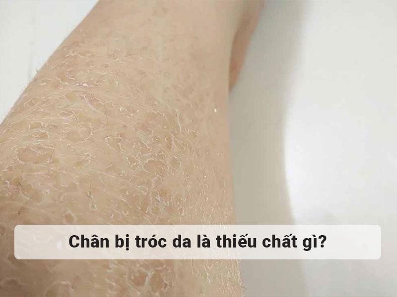 Chân bị tróc da thiếu chất gì để bổ sung phù hợp 2023