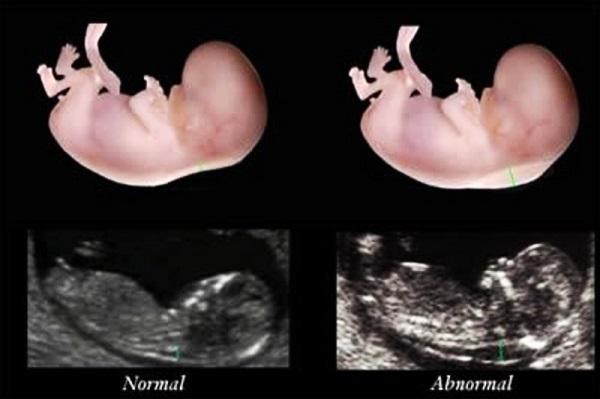 Độ mờ da gáy bình thường có cần làm Double Test không?