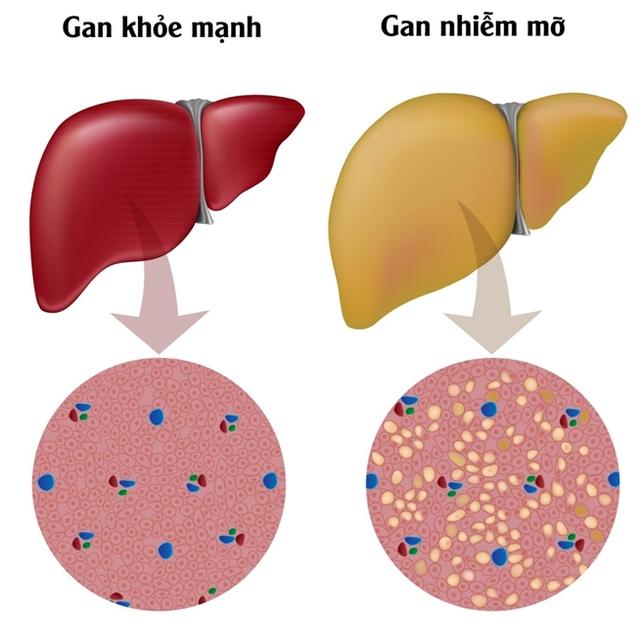 7 loại trái cây người gan nhiễm mỡ nên ăn để giảm tiến triển bệnh