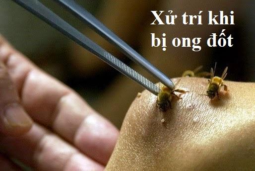 Xử trí khi bị ong đốt