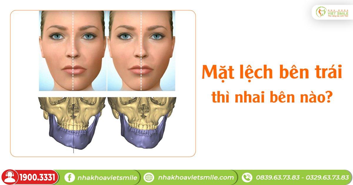 Mặt lệch bên trái thì nhai bên nào? 3 phương pháp khắc phục hiệu quả