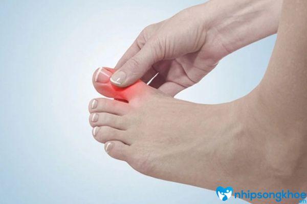 5+ Cách chữa móng chân bị bầm tím hết nhanh chóng