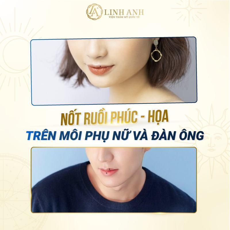 Nốt ruồi ở môi trên dưới của nam nữ có ý nghĩa gì? Có nên tẩy nốt ruồi này không?