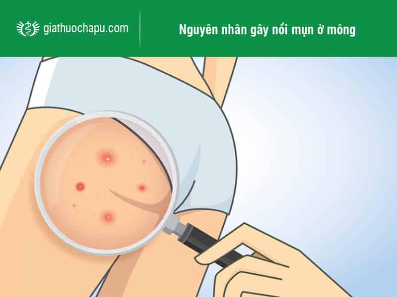 Bị mụn ở mông dùng thuốc gì nhanh khỏi?