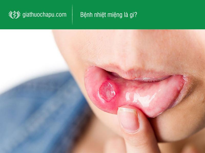 Những loại thuốc nhiệt miệng trẻ em tốt nhất