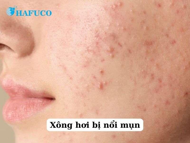 Xông hơi bị nổi mụn vì sao? Cách xông hơi không bị mụn