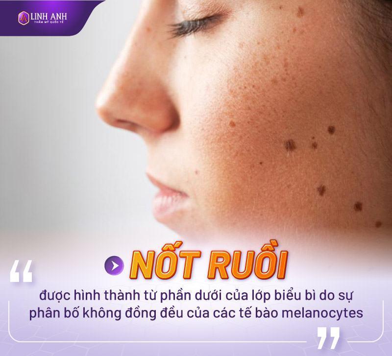 Tẩy nốt ruồi có ảnh hưởng đến tướng số không? Vị trí nốt ruồi không nên tẩy