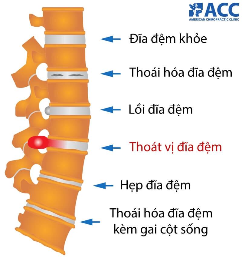 Thoát vị đĩa đệm