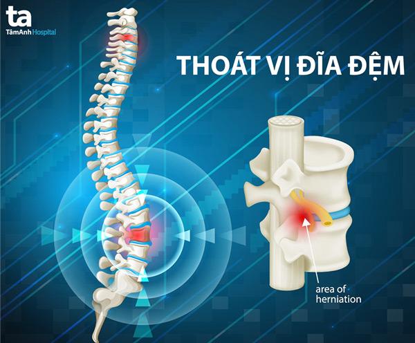 15 phương pháp điều trị thoát vị đĩa đệm hiệu quả nhất hiện nay