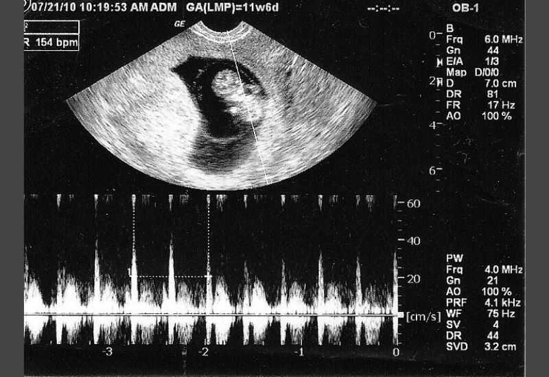 Bác sĩ sản khoa: Đoán giới tính em bé qua nhịp tim thai nhi có chính xác?