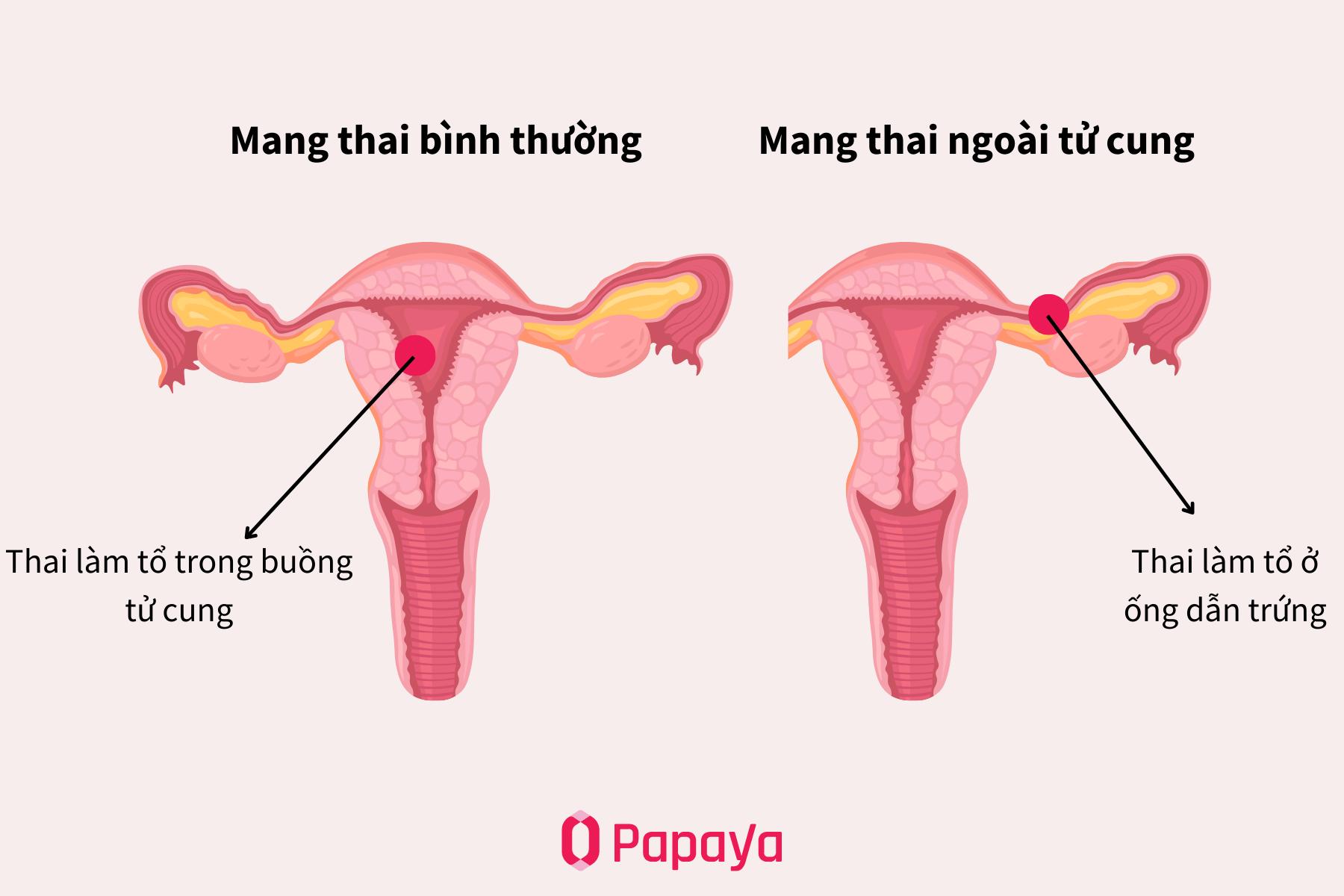 5 điều bạn cần biết về dấu hiệu thai ngoài tử cung tự tiêu