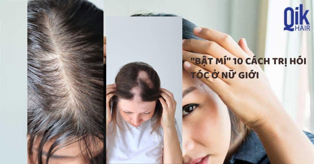 “Bật mí” 10 cách trị hói tóc ở nữ giới đơn giản và nguyên nhân