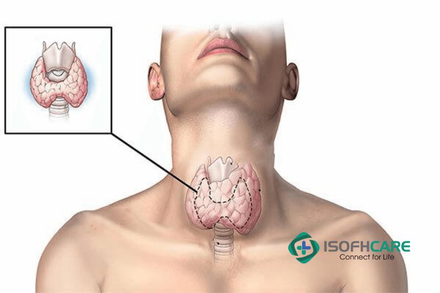 Ý nghĩa của xét nghiệm TSH đối với các bệnh lý của tuyến giáp