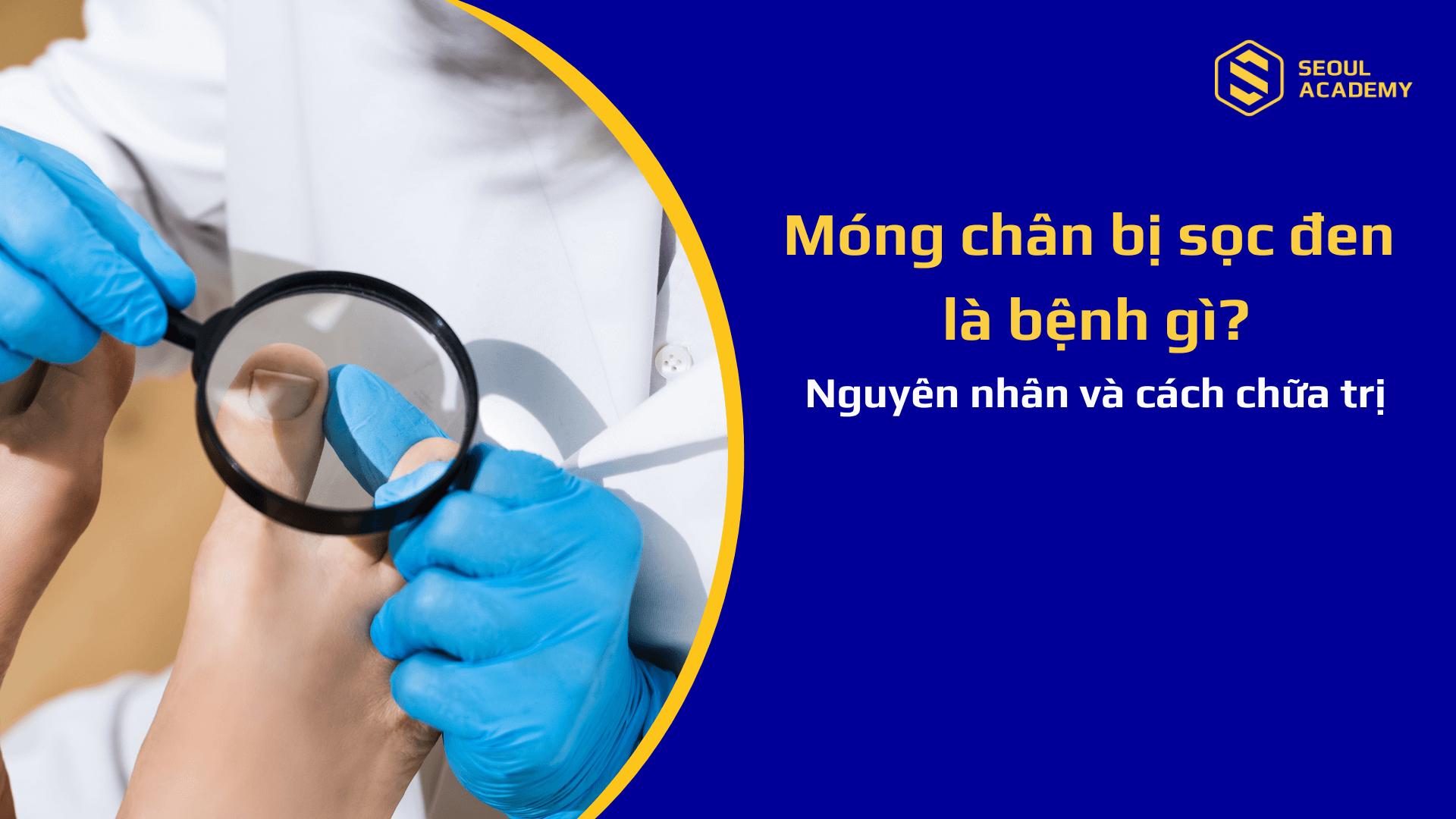 Móng chân bị sọc đen là bệnh gì? Nguyên nhân và cách chữa trị