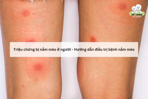 [GIẢI ĐÁP] Biểu hiện người bị nấm mèo và cách điều trị hiệu quả