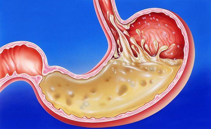 Uống nước gì để giảm axit dạ dày? An toàn, hiệu quả tại nhà