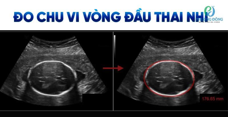 Chỉ số HC trong siêu âm chu vi vòng đầu thai nhi và lưu ý dành cho cha mẹ