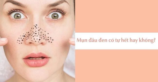 Mụn đầu đen có tự hết được không? Để lâu không nặn có sao?