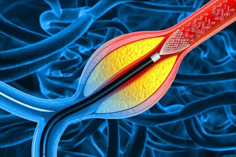 Người đặt stent mạch vành sống được bao lâu?