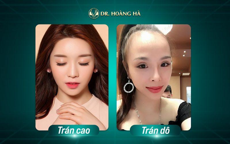 7+ Cách phân biệt trán cao và trán dô – Theo góc nhìn từ chuyên gia