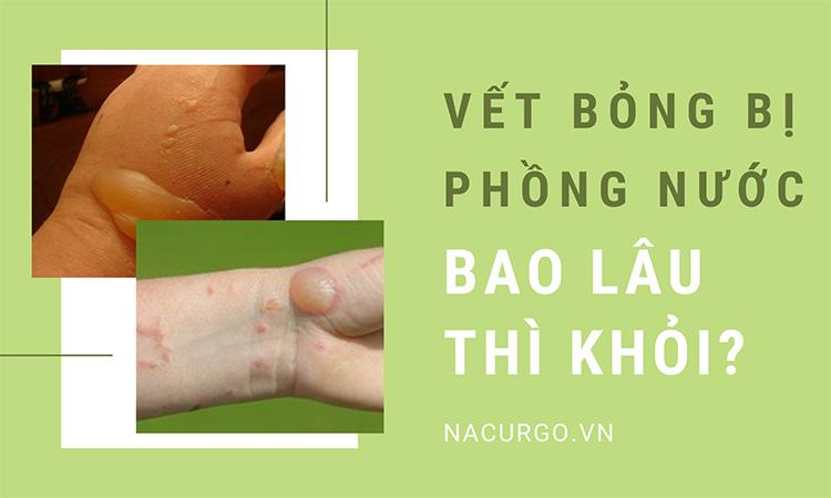 Vết bỏng bị phồng nước bao lâu thì khỏi?