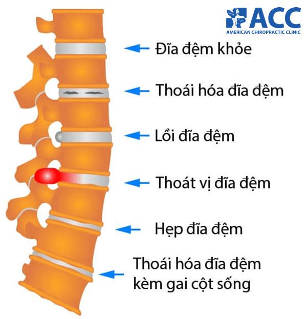 Bệnh nhân thoát vị đĩa đệm nên ăn gì?