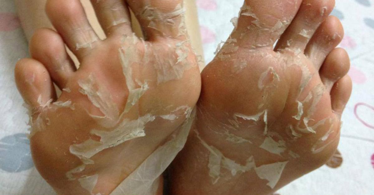 Bệnh tróc da chân: Nguyên nhân, biểu hiện và cách xử lý bệnh tại nhà