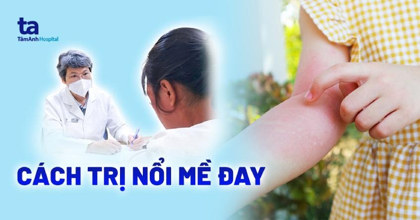 Top 3 cách trị nổi mề đay tại nhà: giảm ngứa, rát cực hiệu quả