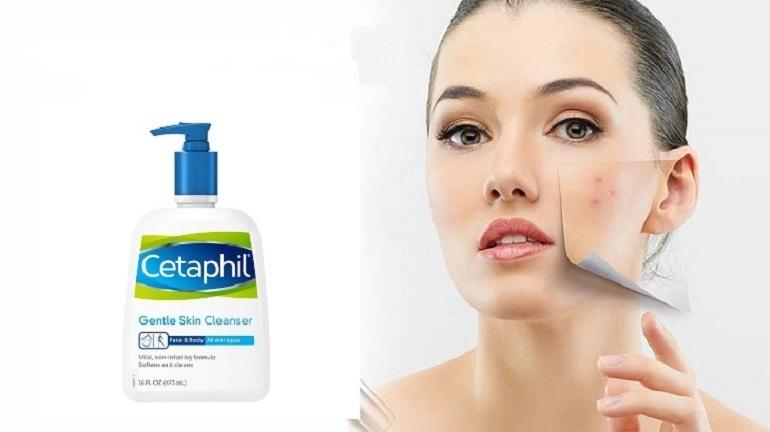 Dùng sữa rửa mặt Cetaphil bị nổi mụn phải làm sao?