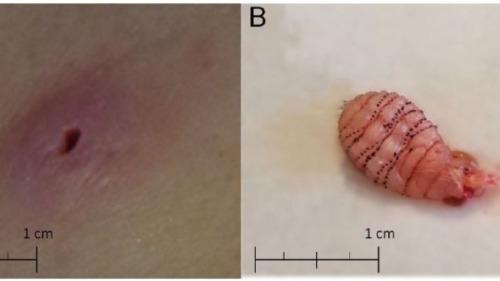 Người phụ nữ Mỹ bị ấu trùng ruồi làm tổ dưới da