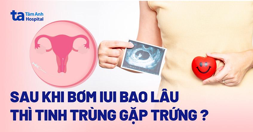 Sau bơm IUI bao lâu thì tinh trùng gặp trứng? Chuyên gia IUI giải đáp