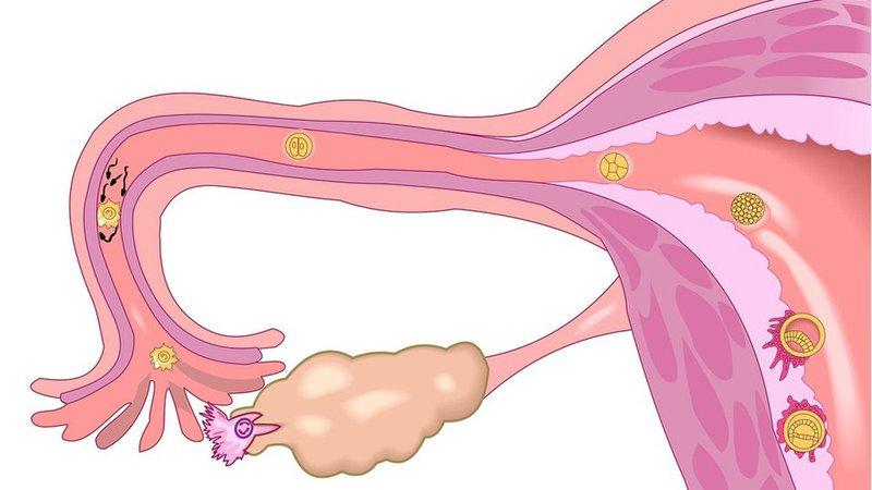 Triệt sản khi sinh mổ có được bảo hiểm không?